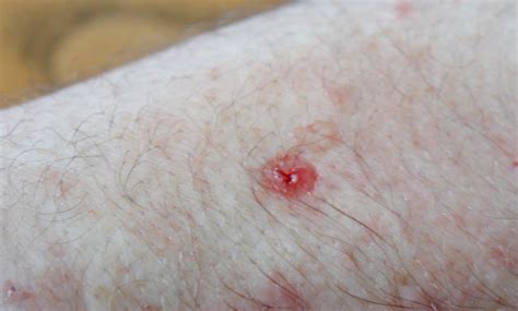 Many possibilities: <b>Itchy</b> bump could be many things including an insect <b>bite</b>, cyst, acne, skin cancer, foreign body reaction, scar/keloid, benign tumor. . Leech bite itchy after 2 weeks